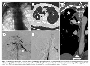 Figure from article: Recurrent haemoptysis due...