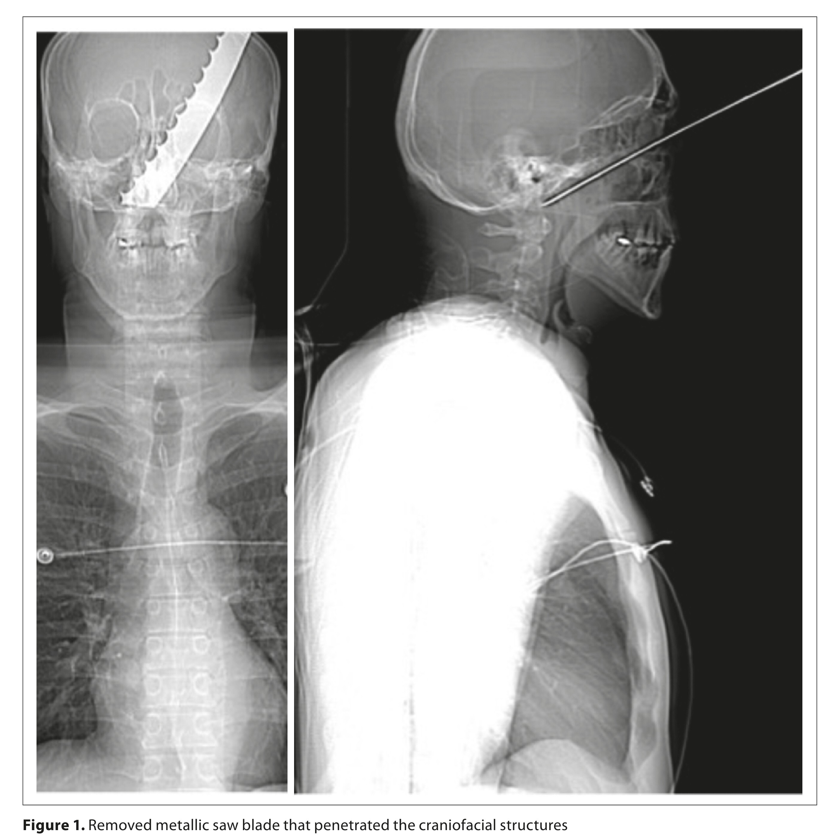 Figure from article: Penetrating craniofacial...
