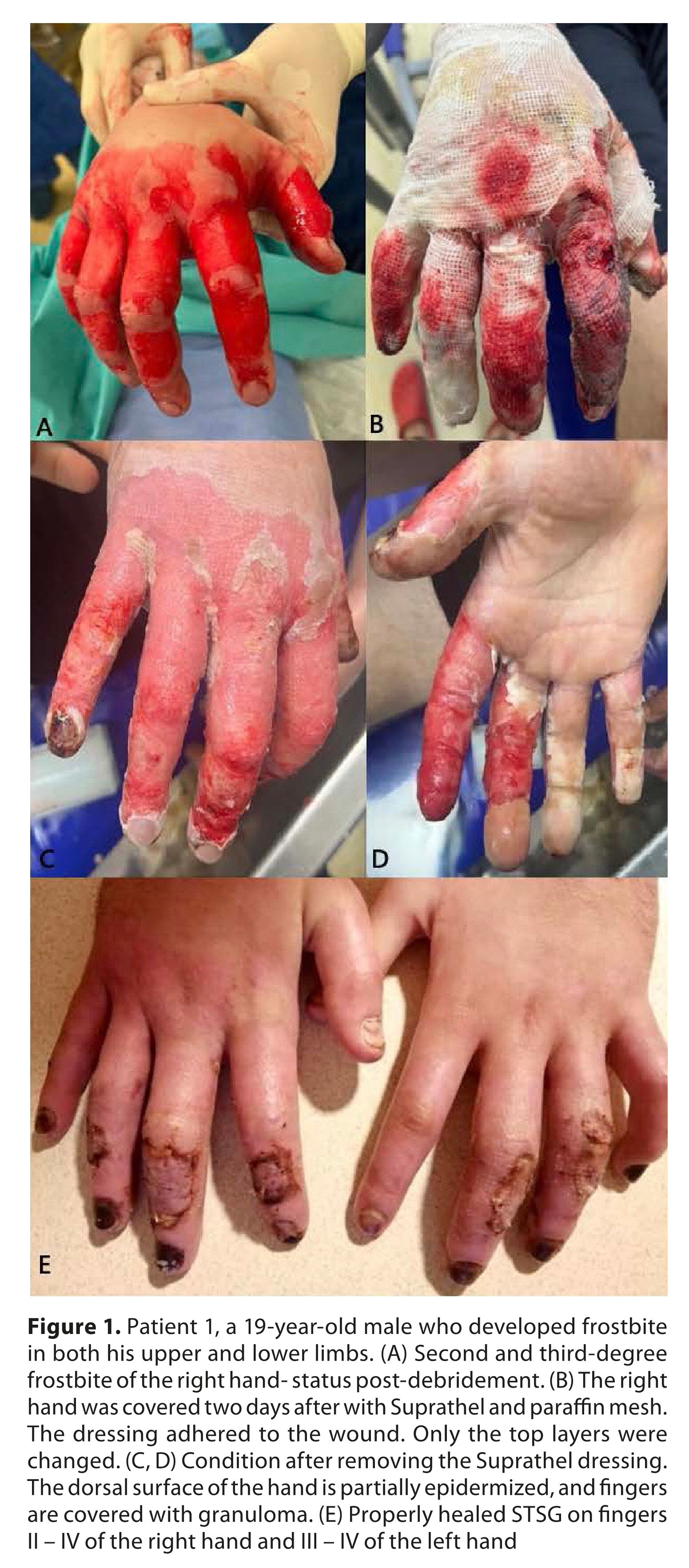 Figure from article: Frostbite management –...